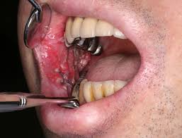 Tongue Cancer