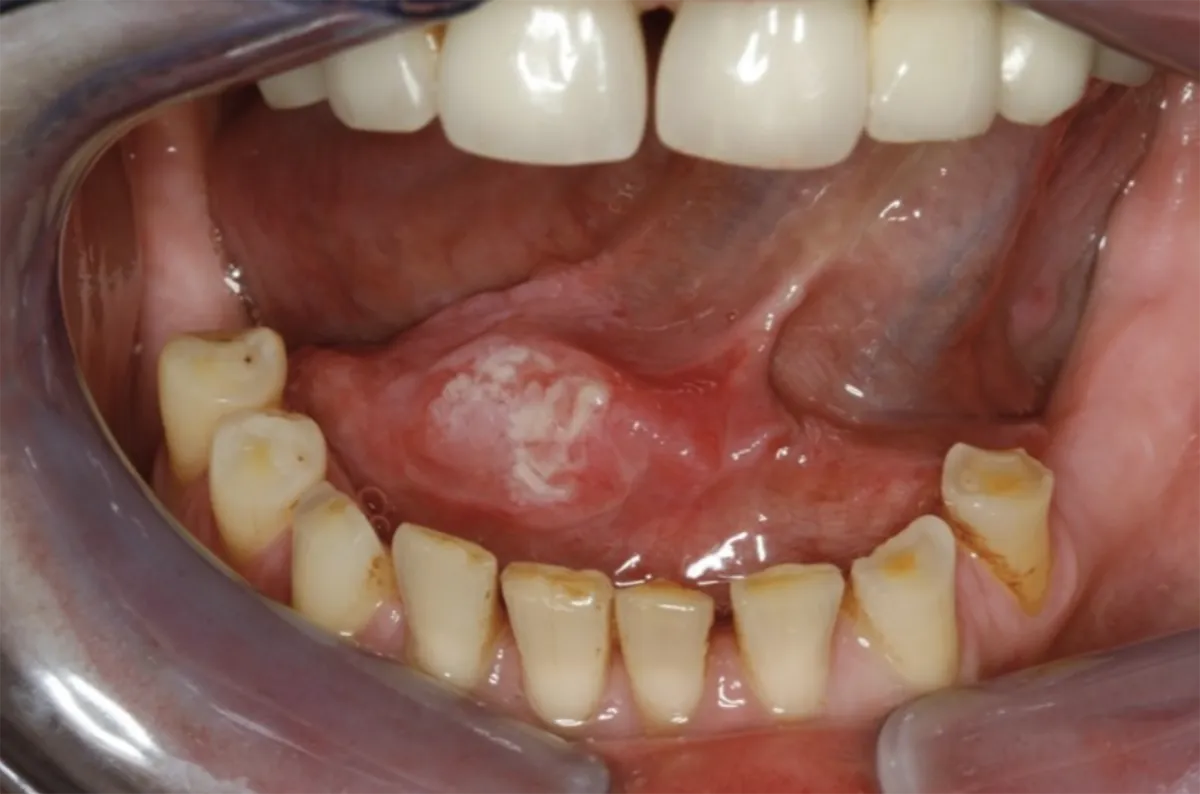 Tongue Cancer