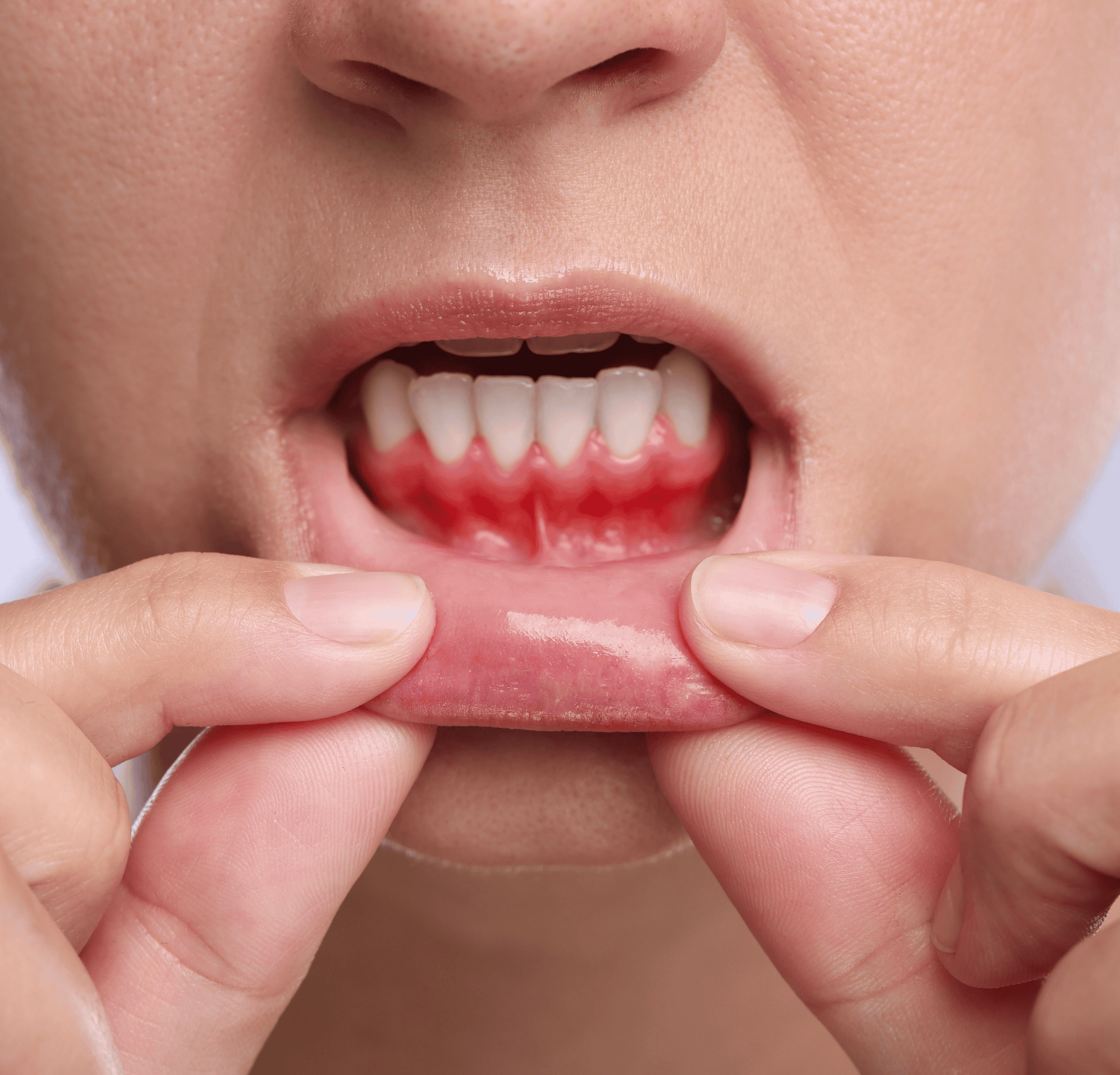 Tongue Cancer