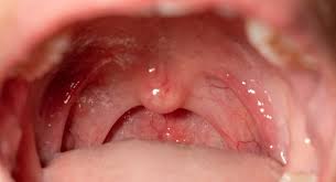 Tongue Cancer