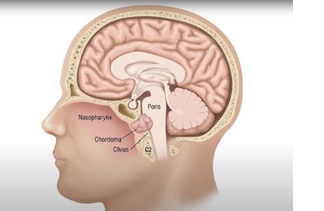 Salivary Gland Surgery