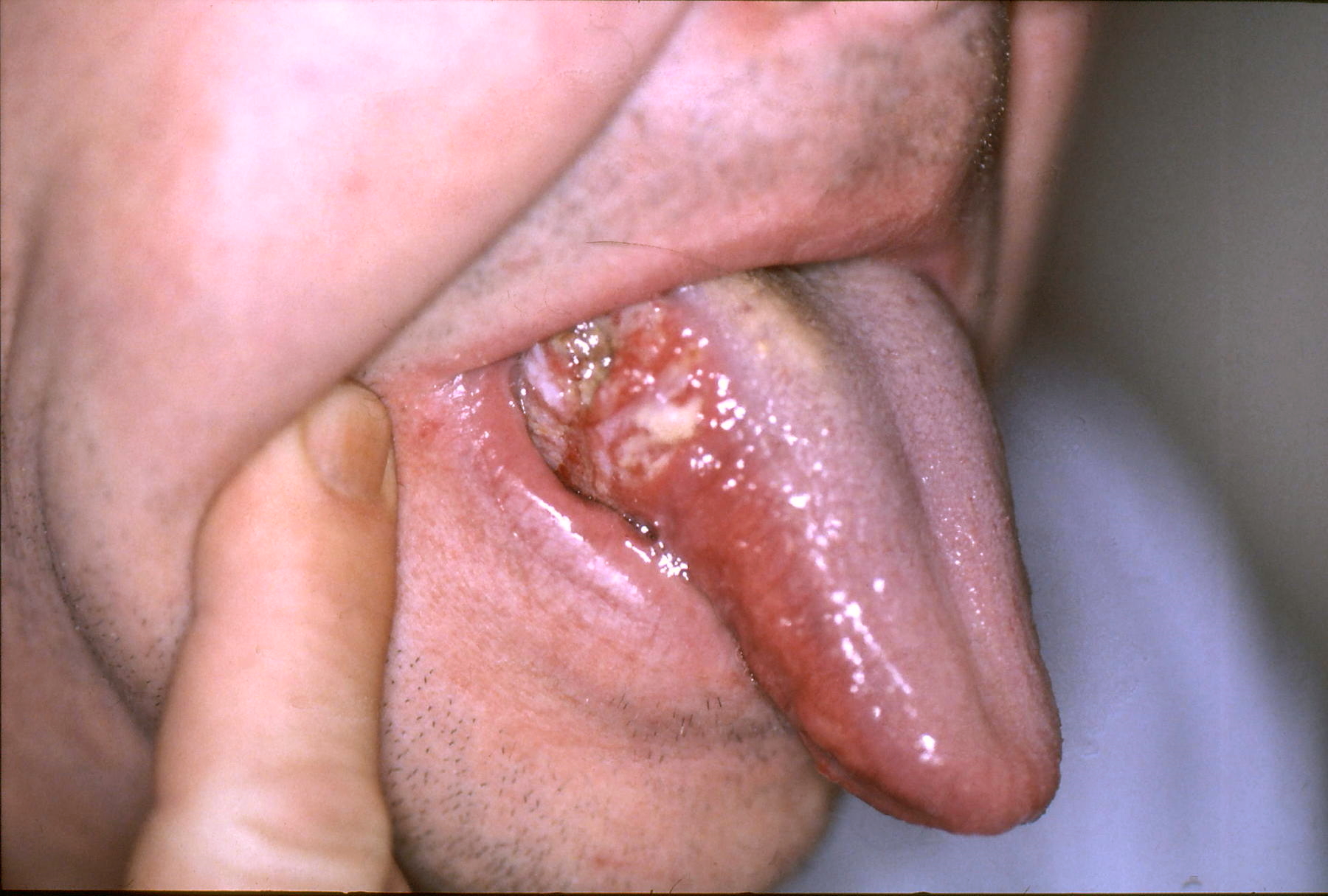 Tongue Cancer